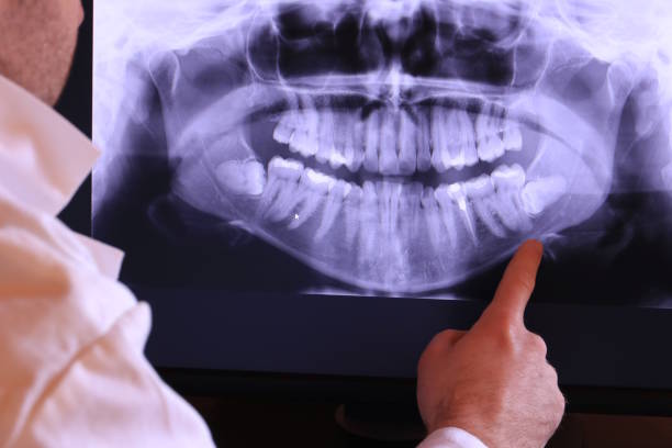 Best Emergency Dental Care for Broken or Chipped Teeth in Radisson, NY